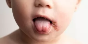 Penyebab herpes pada anak harus dipantau, kenali gejalanya